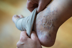 جوراب واریس Varisocks ترکیه